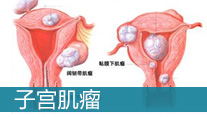 子宮肌瘤的治療方法_西寧婦科醫院