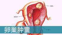 卵巢囊腫的原因_西寧婦科醫院